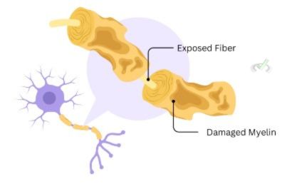 Multiple Sclerosis (Ms)